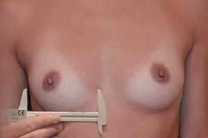 Основна ширина на импланта какъв размер имплант, за да изберете хирург уголемяване на гърдите в Харков