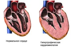 Болест на Фабри причини, симптоми