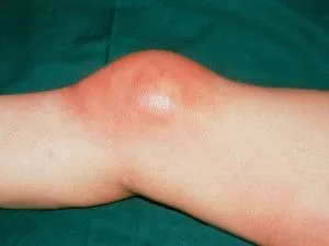 Bursită articulației genunchiului tipuri, simptome, tratament