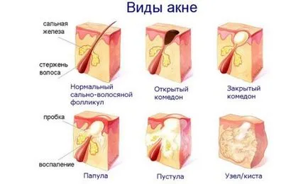 Acid boric pentru acnee pe fața cererii, comentarii