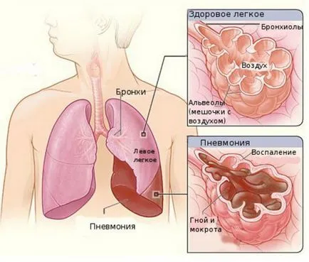 Szegmens tüdőgyulladás betegség és annak jellemzői