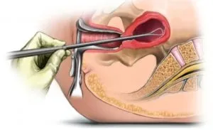 Ceea ce distinge endometrioza simptome de hiperplazie endometrială