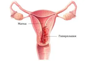 Ceea ce distinge endometrioza simptome de hiperplazie endometrială