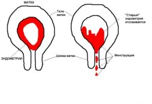 Ceea ce distinge endometrioza simptome de hiperplazie endometrială
