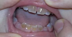 Синдром на Stanton kapdepona и dentinogenesis имперфекта amelogenesis симптоми, лечение