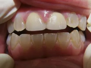 Синдром на Stanton kapdepona и dentinogenesis имперфекта amelogenesis симптоми, лечение