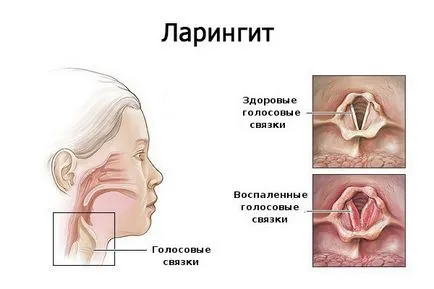 Ce este laringite - tipuri și forme, simptome și tratament