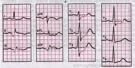 Dinamica modificărilor ECG în acută, subacută și stadiul cicatrice infarctului miocardic și a-la - stadiul acut