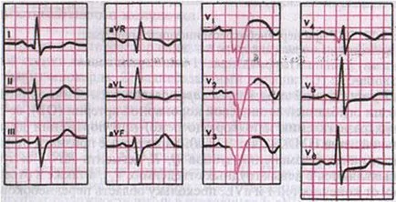 Динамика на ЕКГ промени в остър, подостър и белег етап на инфаркт на миокарда и-по - остър стадий