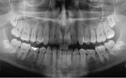 Diagnosticarea cariilor dentare, carii dentare metode de diagnostic (foto)