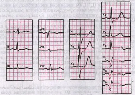 Dinamica modificărilor ECG în acută, subacută și stadiul cicatrice infarctului miocardic și a-la - stadiul acut