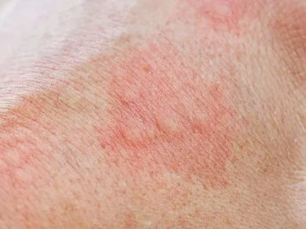 Diagnosztizálására és kezelésére dermatitis