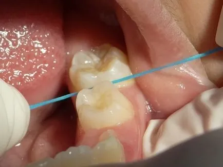 Diagnosticarea cariilor dentare, carii dentare metode de diagnostic (foto)