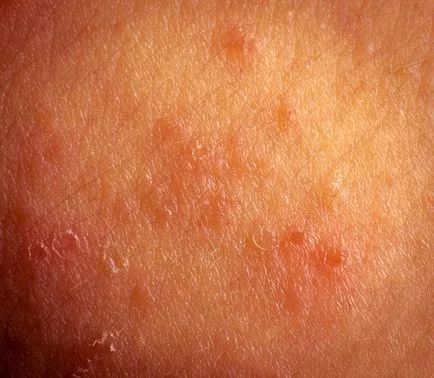 Diagnosztizálására és kezelésére dermatitis