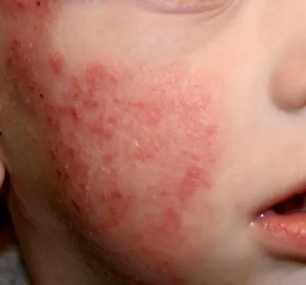 Diagnosztizálására és kezelésére dermatitis