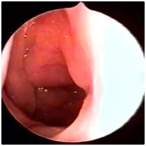 copii adenotomija endoscopica