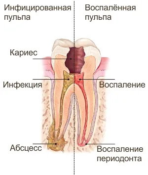 endodontális kezelés