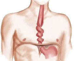Esophagism какво е, причини, симптоми, лечение