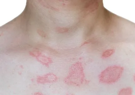 Erythema multiforme exszudatív orális módszerek fizikoterápiás