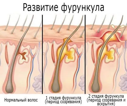 лечение Боил у дома, бързо народни средства