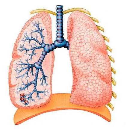 Mustár bronchitis adott alkalmazás