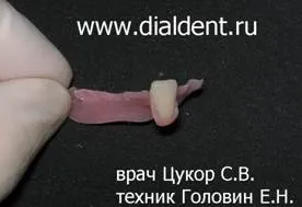 A fogászati ​​implantátumok serdülőknél nem vonható! van egy alternatív