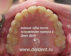 A fogászati ​​implantátumok serdülőknél nem vonható! van egy alternatív