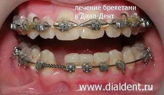 Implanturile dentare la adolescenti nu poate avea loc! există o alternativă