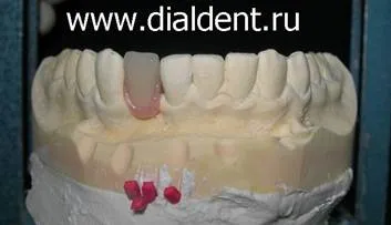 Implanturile dentare la adolescenti nu poate avea loc! există o alternativă