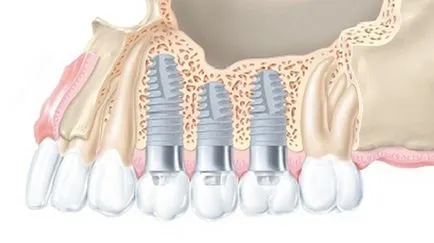 Implanturile xive preț friadent, instalare și sfaturi privind îngrijirea, implanturi Catalog XiVE
