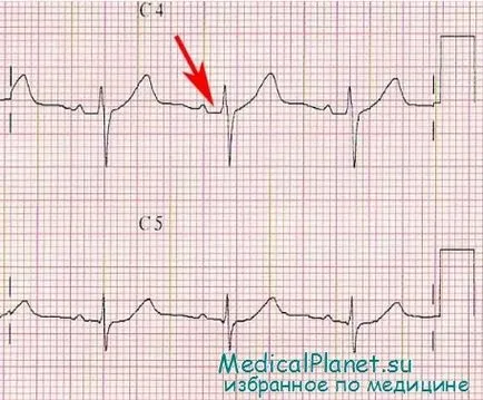 infarct miocardic si ruptura atriale a mușchilor papilari