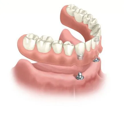 Implanturile dentare - un pas cu pas protocol