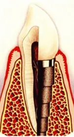 Историята на зъбни импланти 2
