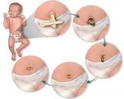 Като обработка на пъпа е направено правилно при новороденото