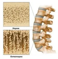 Как е остеопороза при жени - причината на заболяването често се счупва как да разпознават остеопороза в