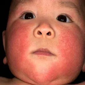 Hogyan működik az allergia csecsemők a keverékben, amely az allergiás rhinitis tüneteinek - minden, ami