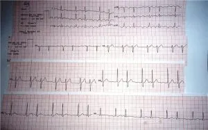 Mint látható az EKG-jelei pitvarremegés