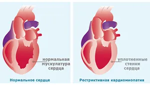 Кардиомиопатия - какво е това, симптоми, лечение, видове