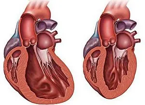 Cardiomiopatia - ce este, simptome, tratament, tipuri