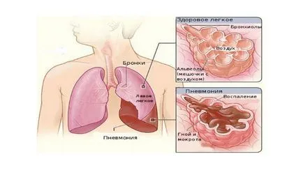 Köhögés után influenza - tünetek tüdőgyulladás