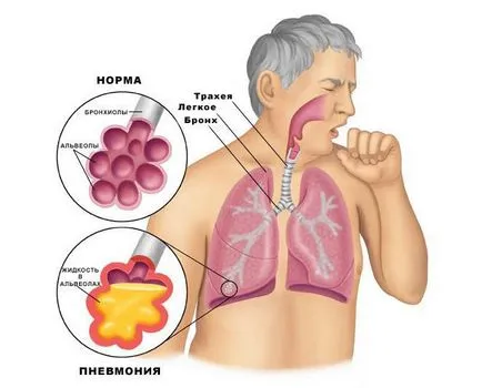 Tuse dupa gripa - simptome de pneumonie