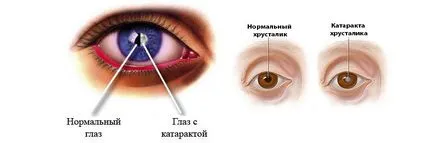 Катаракта на очите - това е, видовете и причините за