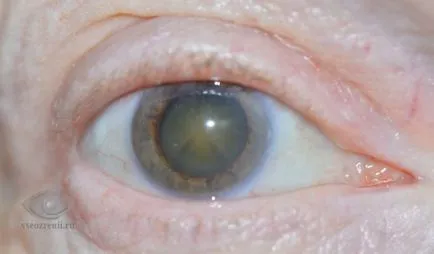 Cataracta (cataractă) tratament, simptomele, cauza, prevenirea