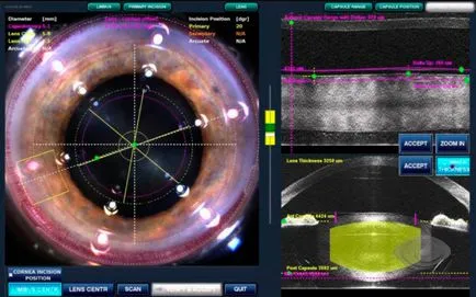 Cataract (cataracta) kezelésére, a tünetek, okát, a megelőzés