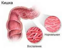 Tratamentul Colita de alimente - intestinului -dacă boala () - ENDIF - Articole Directory - Proctologie - Simptome si