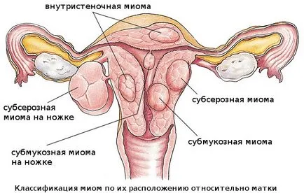 Sangerarea fibrom uterin cum să se oprească, regal, tratament, ce să facă