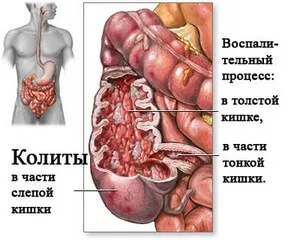 Colita intestinale de droguri - cauze, simptome, tratament