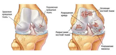 Tratamentul de boli ale genunchiului prin intermediul unor exerciții