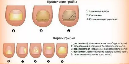 Tratamentul de ciuperci de unghii metode eficiente de remedii populare cu laser și droguri