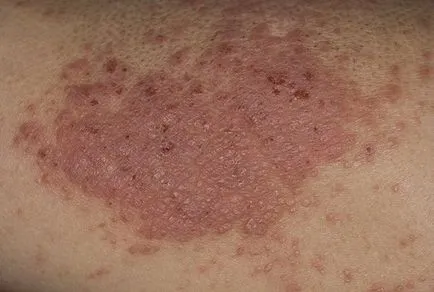 Tratamentul eczemelor oțet de cidru - trăi sănătos